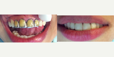 Dental Crown before and after photo