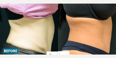 Emsculpt before and after photo