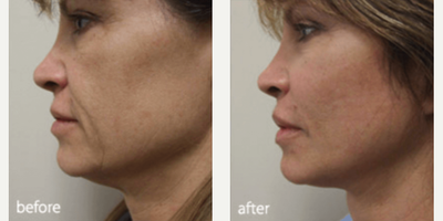 Facelift before and after photo