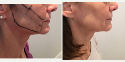 Silhouette Soft before and after photo
