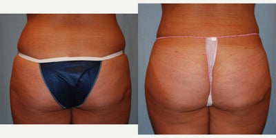 Butt Augmentation before and after photo