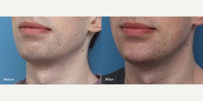 Chin Implant before and after photo