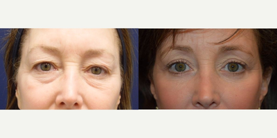 Eyelid Surgery before and after photo