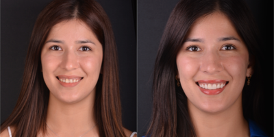 Porcelain Veneers before and after photo