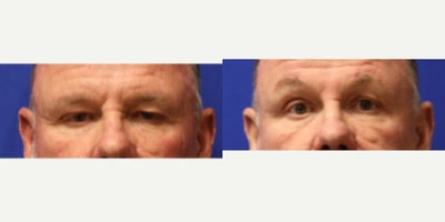 Eyelid Surgery before and after photo