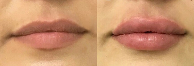 Juvederm before and after photo