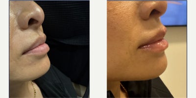 Lip Lift before and after photo