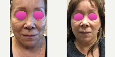PRP Injections before and after photo
