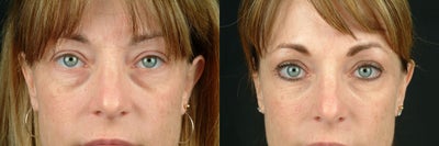 Restylane before and after photo
