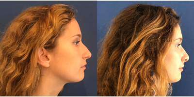 Rhinoplasty before and after photo