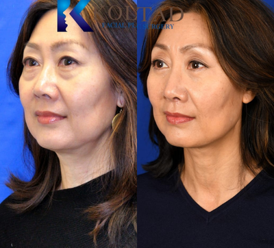 Asian Rhinoplasty before and after photo