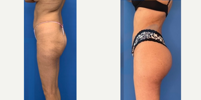 Butt Implants before and after photo
