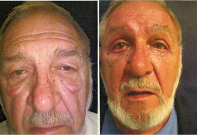 Eyelid Surgery before and after photo