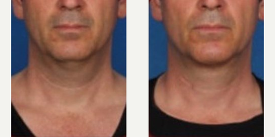 Kybella before and after photo