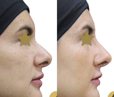 Nonsurgical Nose Job before and after photo