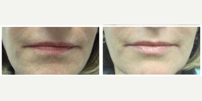 Restylane Silk before and after photo
