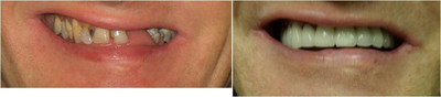 Smile Makeover before and after photo