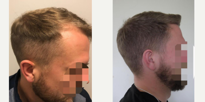 Hair Transplant before and after photo