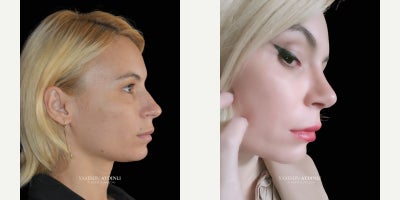Rhinoplasty before and after photo