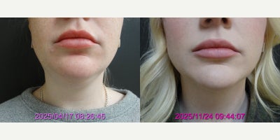 Chin Liposuction before and after photo
