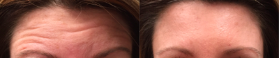 Dysport before and after photo