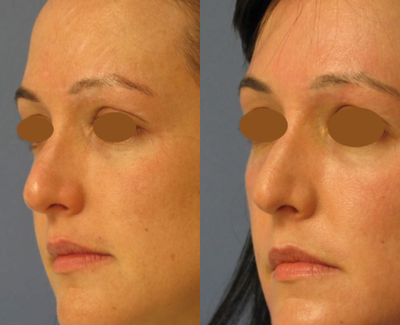 Fraxel Laser before and after photo