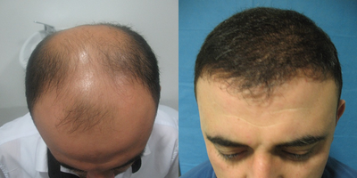 Hair Transplant before and after photo