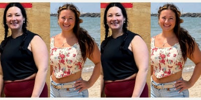 Liposuction before and after photo
