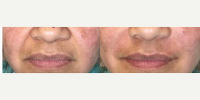 Radiesse before and after photo