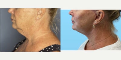 Neck Lift before and after photo