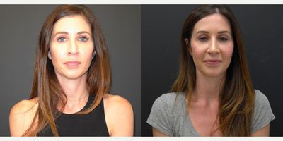 Revision Rhinoplasty before and after photo
