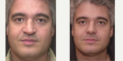 Rhinoplasty before and after photo