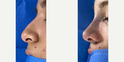 Rhinoplasty before and after photo