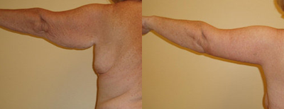 Arm Lift before and after photo