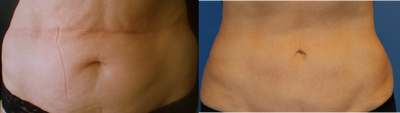 CoolSculpting before and after photo