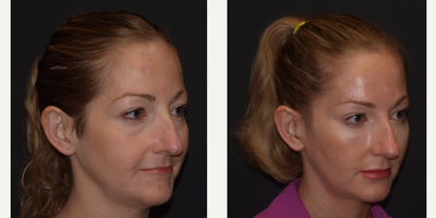 Eyelid Surgery before and after photo