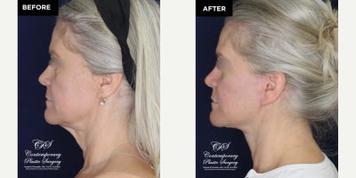 Eyelid Surgery before and after photo