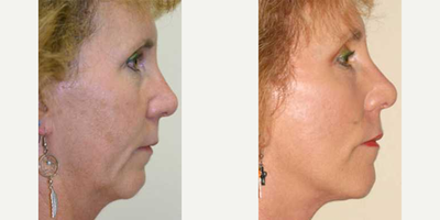 Neck Lift before and after photo