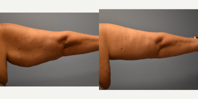 Arm Lift before and after photo