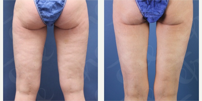 Cellulaze before and after photo