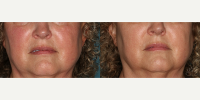 Excel V before and after photo