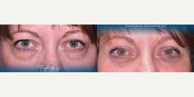 Eyelid Surgery before and after photo