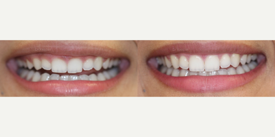 Gum Lift before and after photo