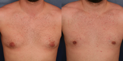 Gynecomastia Surgery before and after photo