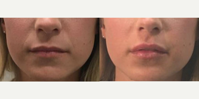 Lip Fillers before and after photo