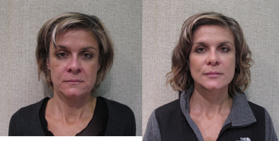 Neck Lift before and after photo