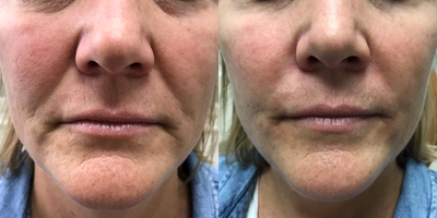 Radiesse before and after photo