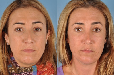 Revision Rhinoplasty before and after photo
