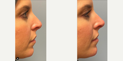 Rhinoplasty before and after photo
