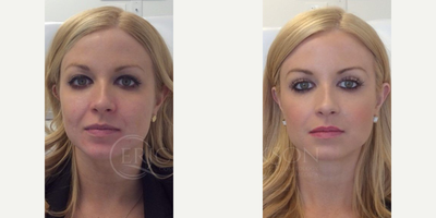 Skin Rejuvenation before and after photo